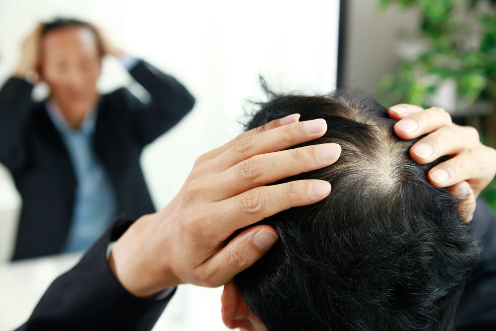 탈모약 급여 논의까지 나온 시대…&#...